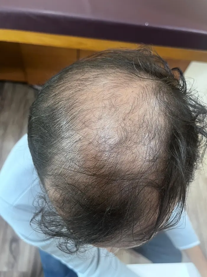 Male Pattern Baldness case 4 before treatment
